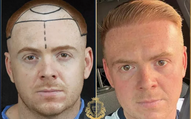 Turkey Hair Transplant: Cost, Procedure, and What to Expect in 2024