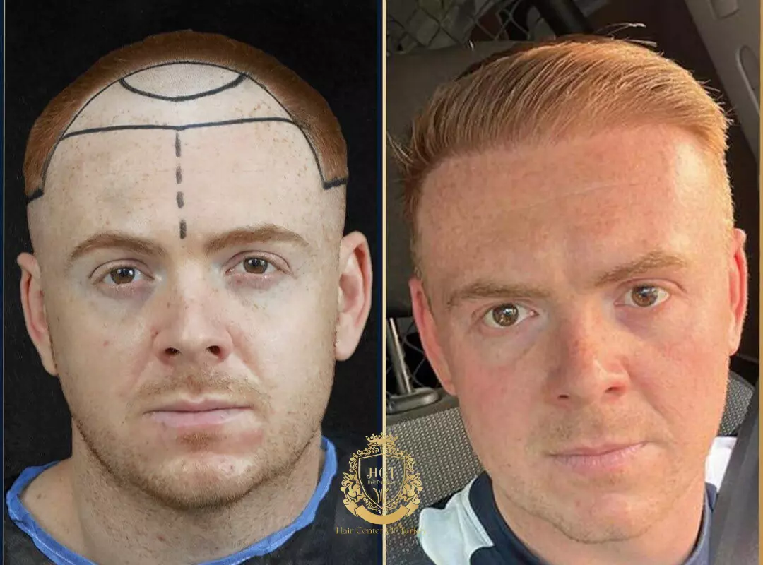 Turkey Hair Transplant: Cost, Procedure, and What to Expect in 2024